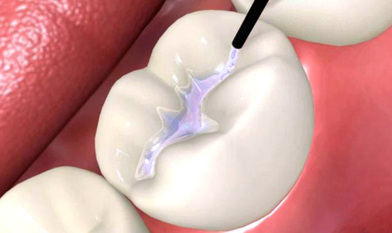 Dental Sealants | Family Dentist in Brooklyn, MN- Brooklyn Blvd Dental
