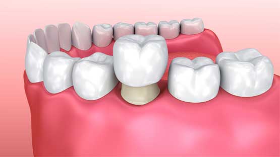 Porcelain Crowns- Family Dentist in Brooklyn,MN | Brooklyn Blvd Dental