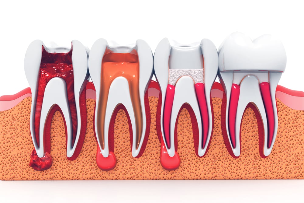 Root Canal Therapy | Family Dentist in Brooklyn | Brooklyn Blvd Dental